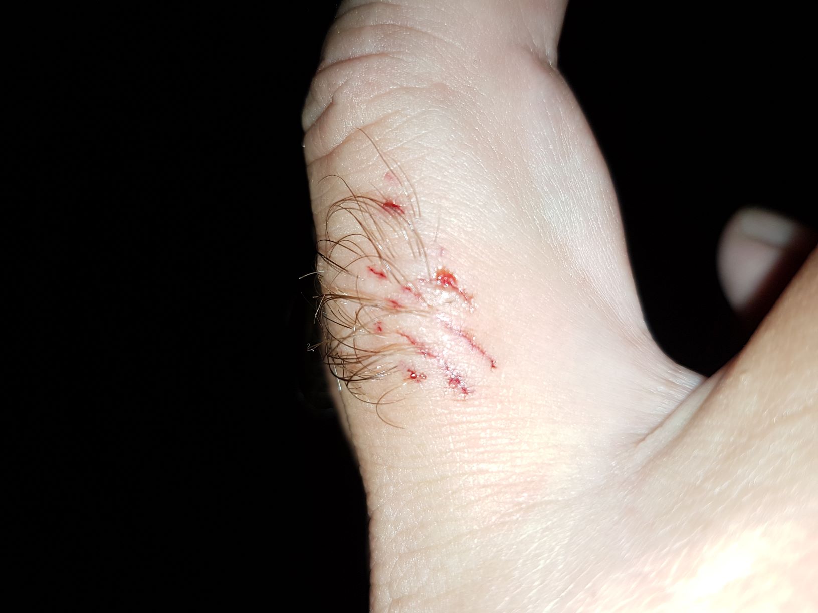 Ugryzienie mureny 1.jpg