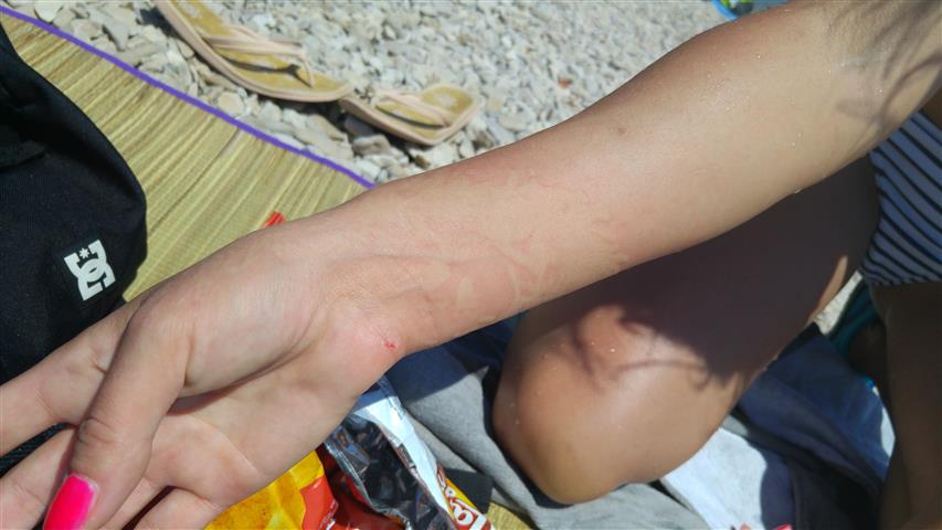 chwilę po oparzeniu / 20170707_134917 (Small).jpg 20170707_134917 (Small).jpg