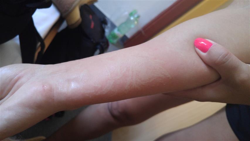 chwile po oparzeniu / 20170707_142631 (Small).jpg 20170707_142631 (Small).jpg