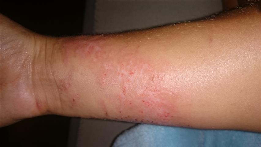 po odpadnięciu strupków / DSC_0037 (Small).JPG DSC_0037 (Small).JPG